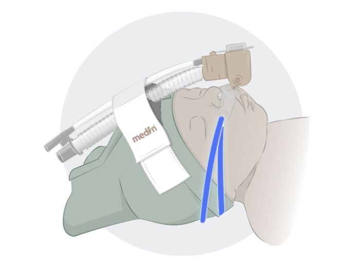 Тесемки для аппарата СРАР терапии CNO одноразовые, длина 18 см